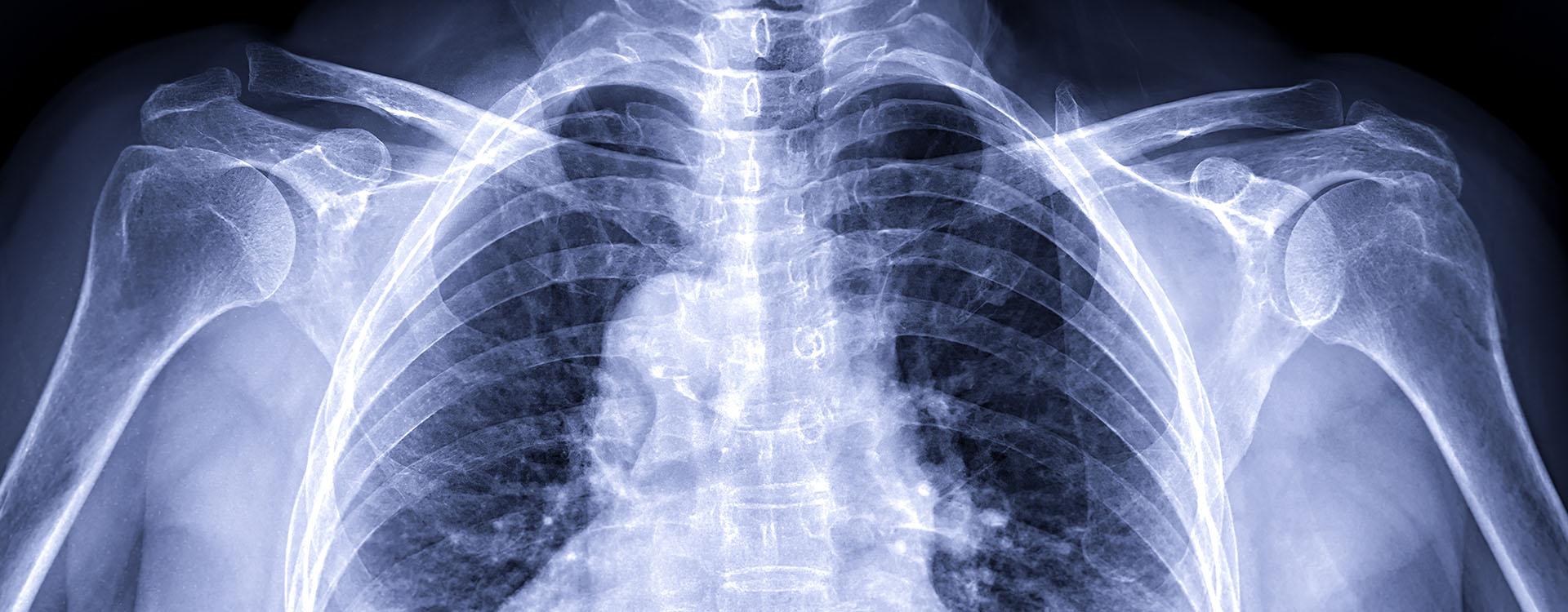 X-ray shoulder transaxillary view for diagnosis fracture